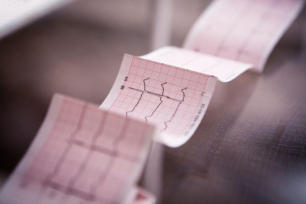 EKG sydänfilmi sydämen rytmihäiriöstä
