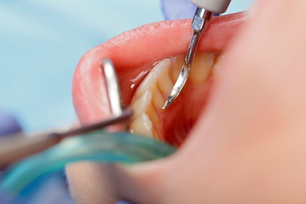 Hammaskiveä poistetaan hammaslääkärissä.